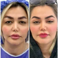 دایرکت ابرو8 بلفاروپلاستی 7لیفت تحتانی9سانترال لب8