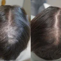 فقط یک مشاوره تا پیدا کردن علت ریزش مو