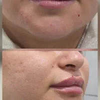 بوتاکس،فیلر، مزو فقط توسط پزشک بدون چهره مصنوعی