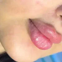 تزریق ژل بوتاکس مزوتراپی سر وصورت