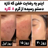 بهبود انواع لک های صورت ،بارداری و ملاسما