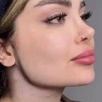 جشنواره تزریق تخصصی ژل لب و فرم دهی صورت 750 تومان
