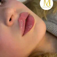 ژل و بوتاکس فقط۵۵۰ به مدت۵ روز توسط پزشک