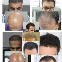 کاشت موی طبیعی با بالاترین تراکم