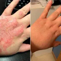 بهبود پسوریازیس و پیسی