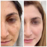 کرم ضد لک بیوممتیک  (جایگزین لیزر)+تحویل درب منزل