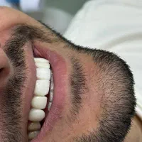 دندانپزشکی لمینت اقساطی