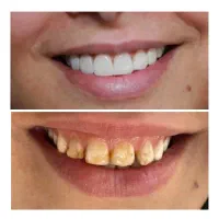 جشنواره خدمات دندانپزشکی با تعرفه دولتی