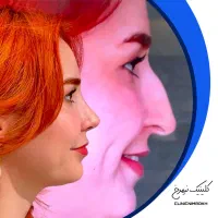 جشنواره ویژه عمل بینی