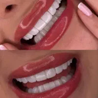 تکنیک جدید کامپوزیت / دندانپزشکی