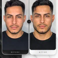 جشنواره پاییزه ژل،فیلر،لیفت،بوتاکس،جوانساز