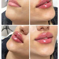 تخفیف ویژه ژل و بوتاکس تا اخر هفته تحت نظر پزشک