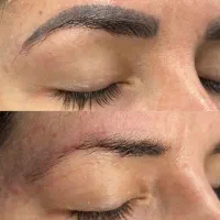 پاک کردن تتو و خالکوبی با دستگاه لیزر(تخفیف ویژه)