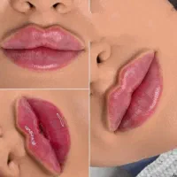 ۵ سال جوانتر با فیلر و ژل نسخه بهتر خودتان باشید