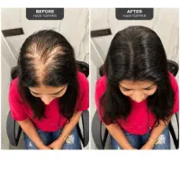 پک معجزه اساضدریزش و رویش مجدد مو جایگزین کاشت مو
