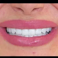 دندان مصنوعی طرح لمینیت برای افرادجوان