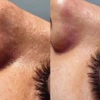 فیشیال 400موخوره گیری 300اصلاح خیس200