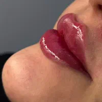 جشنواره تزریق فیلروژل بوتاکس جوانسازی مادلینگ صورت