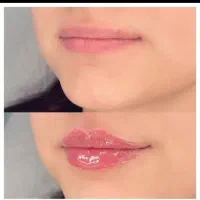 فیلر بادی ۲۵۰بوتاکس ۷۵۰ جراحی لیفت ابرو ۲۰ م