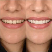 کامپوزیت دندان اقساطی در اصفهان + مشاوره رایگان