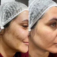 وایتنینگ ورفع لک صورت ونواحی بدن دریکجلسه،ریموتتو