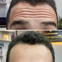 انجام خدمات بوتاکس