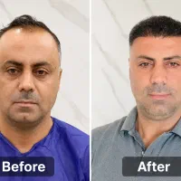 جشنواره کاشت مو فقط با ۱۹ میلیون