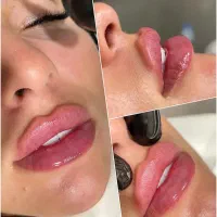 فیلر/ بوتاکس/کانتورینگ صورت