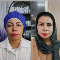 جراحی بلفارو با قیمت باور نکردنی
