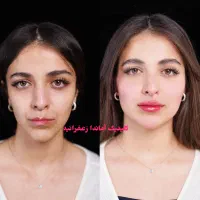 کلینیک تخصصی پوست هایفو ژل نخ مزوژل آموزش ژل