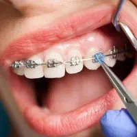 ارتودنسی با اقساط ۲۴ ماهه بدون سود