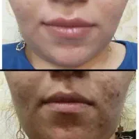 اگه میخوای صورتت صاف شفاف باشه بیا پیوی