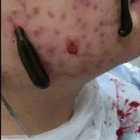 حجامت،زالودرمانی، بادکش،کایروپراکتیک، 15سال تجربه
