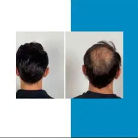 کچلی میخوای موهای بلندی داشته باشی