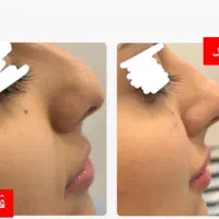 کوچیک شدن بینی تضمینی در منزل
