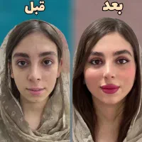 تخفیف۴۰٪ لیفت ژل فیلربادی لب ابرو بینی باسن زاویه