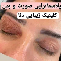 (پلاسماتراپی) برای کسانی که مخالف جراحی هستند