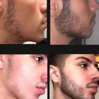 با کم پشتی ریشات خدافظی کن