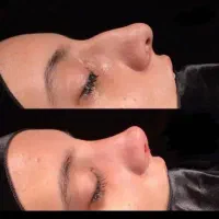 جراحی بینی از۲۹ تومان/لیفت صورت/بلفارو/ابدومینو/