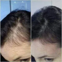 ریزش موهاتــون برطرف میشه