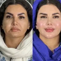 جشنوارفقط تا4شنبه/بدون تزریق/هایفوفقط890ت/1جلسه