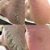 پدیکورتخصصی ژلیش پا(باهزینه موادفقط)