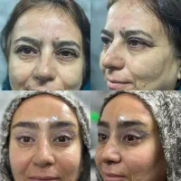 کلینیک زیبایی جراحی لیفت بلفاروپلاستی فیلر بوتاکس