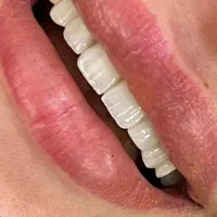روکش زیرکونیا/ایمپلنت کره ای/ونیر