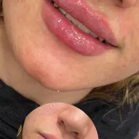 زیبایی و جوانسازی در یک جلسه