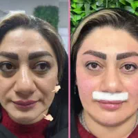 پنجاه درصد تخفیف آموزش تزریق ژل و بوتاکس جوانساز