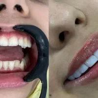 کامپوزیت دندان طرح زیبایی لبخند در اهواز