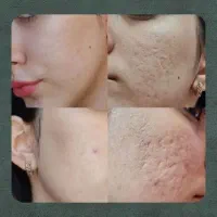 پوستت میخای بدون جوش و لک باشه بیا اینجا