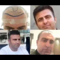کاشت مو وابروی تخصصی فقط با مبلغ ۲۵ میلیون تومان