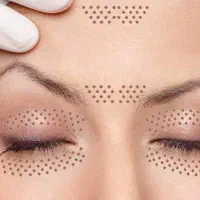 راهنمایی در باره پلکسر پلاسما و هایفوتراپی صورت